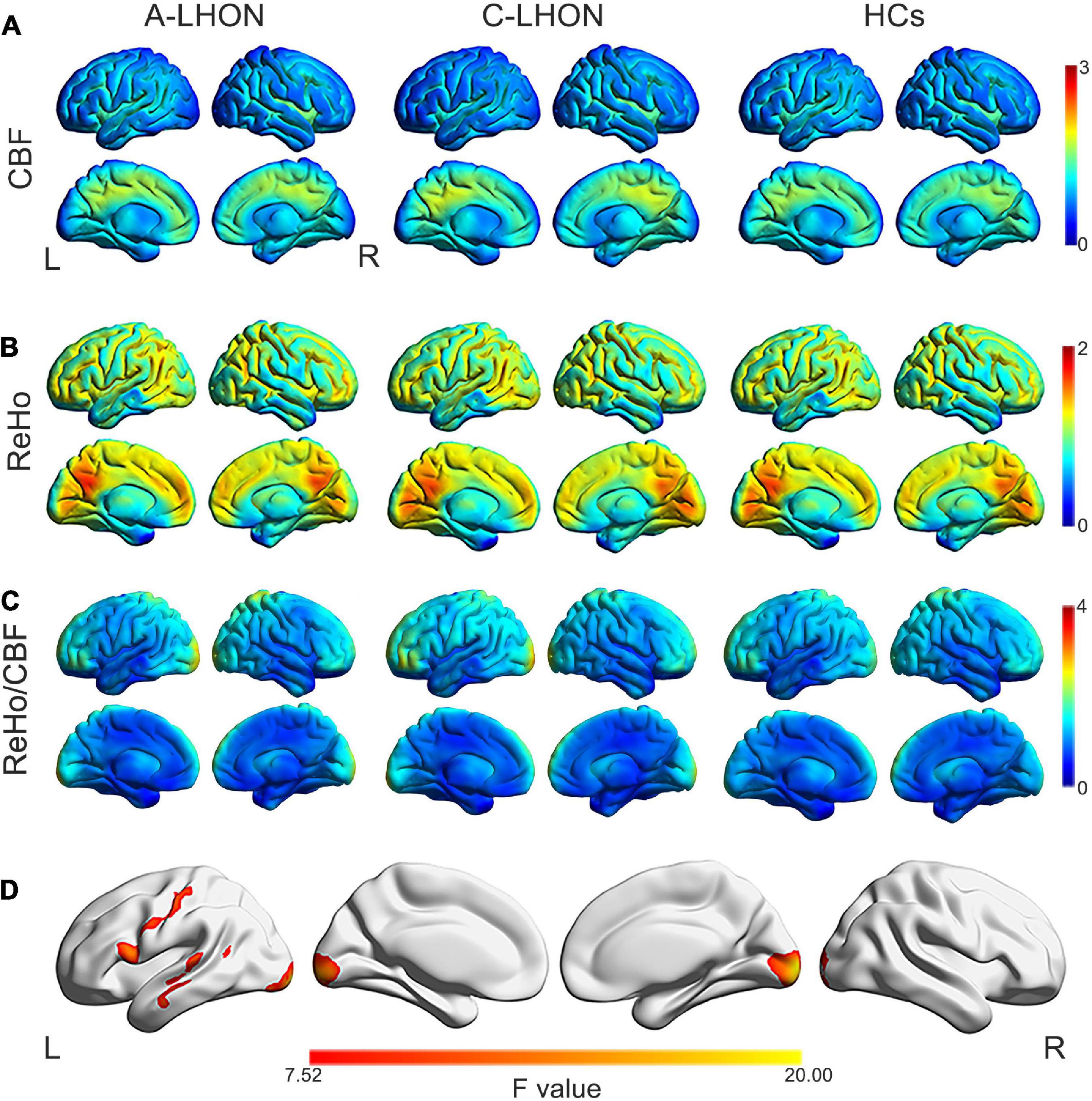 Aberrant neurovascular coupling in Leber’s hereditary optic neuropathy: Evidence from a multi-model MRI analysis